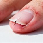 Nagel löst sich vom Nagelbett nach Verletzung