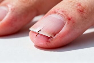 Nagel löst sich vom Nagelbett nach Verletzung